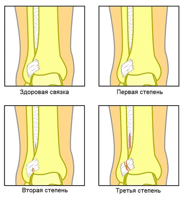 Здоровая связка и при растяжении