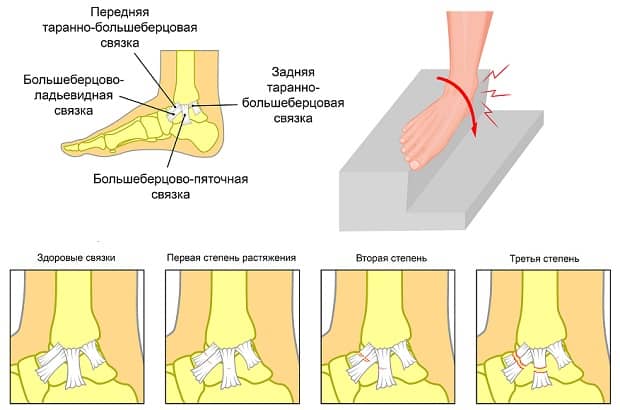 Эверсия голени