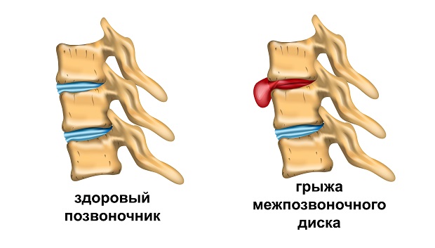 грыжа позвоночника