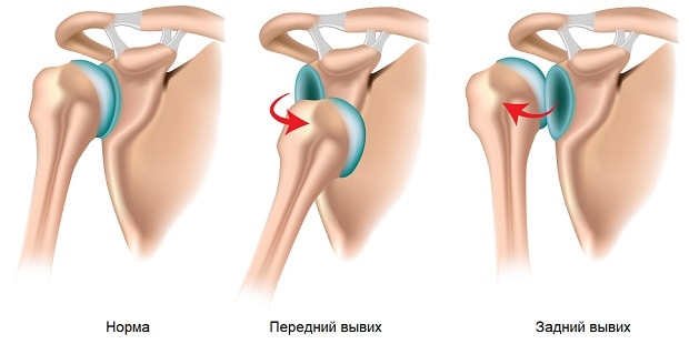Передний и задний вывихи плеча