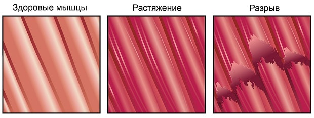 Растяжение и разрыв мышц