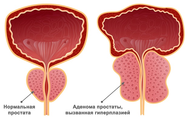 доброкачественная гиперплазия предстательной железы