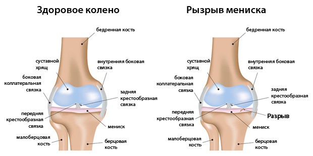 Разрыв мениска и здоровое колено