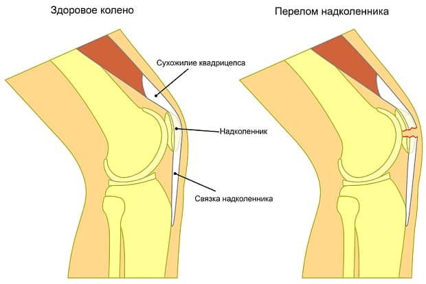 Перелом надколенника