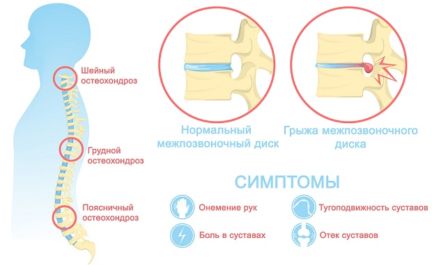остеохондроз инфографика