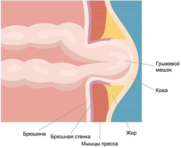Строение брюшной области при грыже
