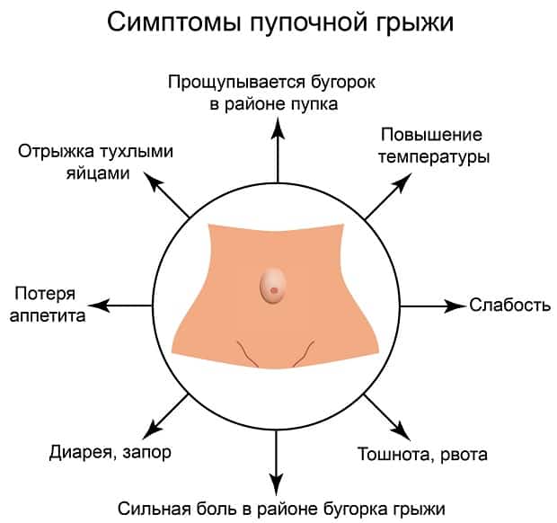 Симптомы пупочной грыжи