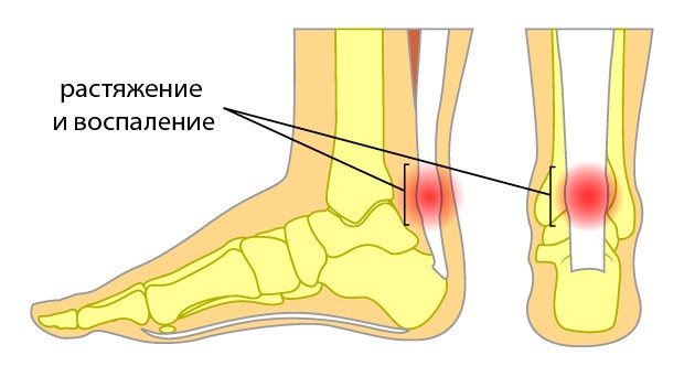 Растяжение сухожилия