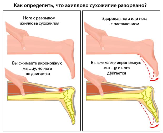 Как понять, что сухожилие разорвано