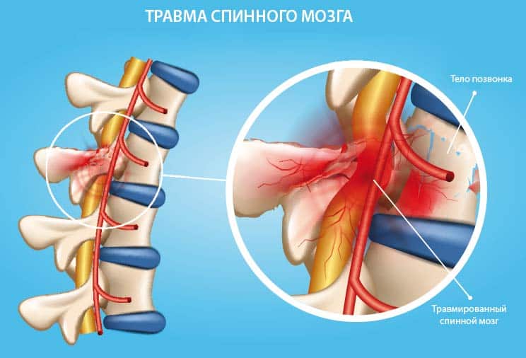 Травмированный спинной мозг