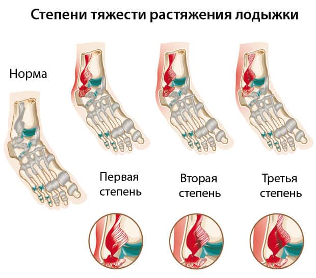 Степени тяжести растяжения лодыжки