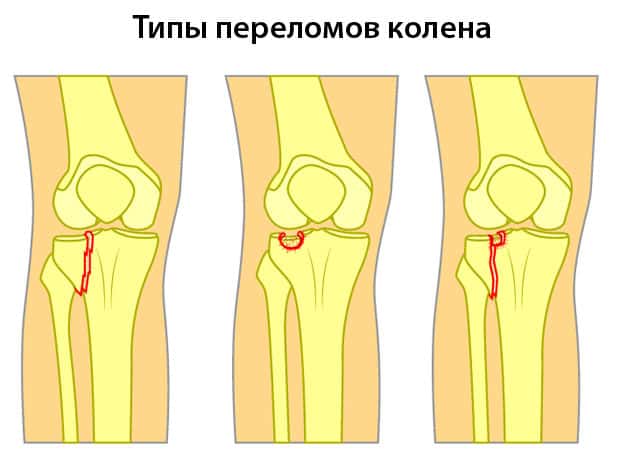 Разные переломы колена