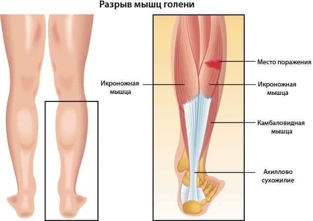 Разрыв икроножной мышцы