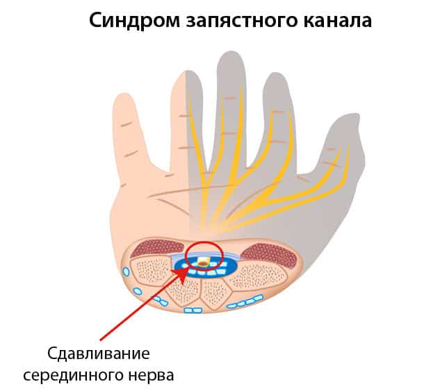 Изображение синдром запястного канала