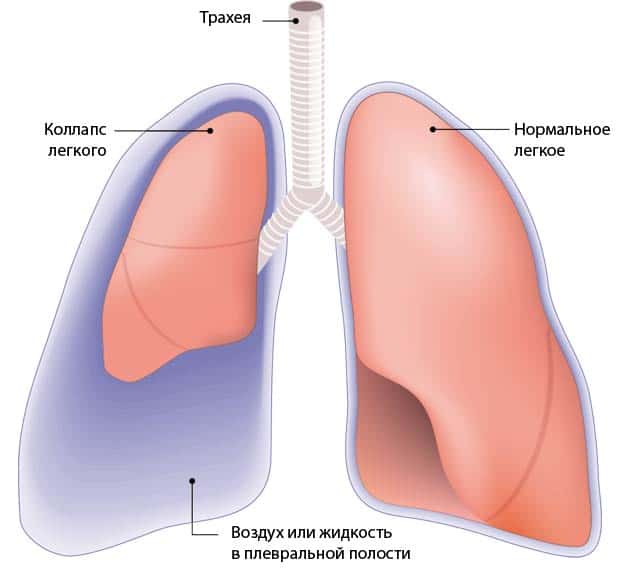Что такое Пневмоторакс