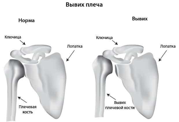 Вывих плеча