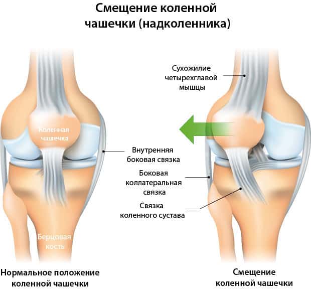Нормальное состояние и смещение надколенника