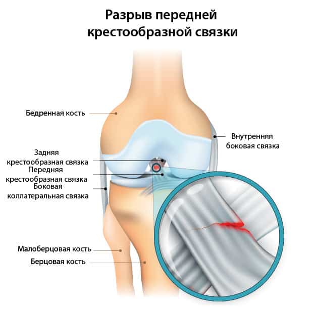 Схема разрыва передней крестообразной связки