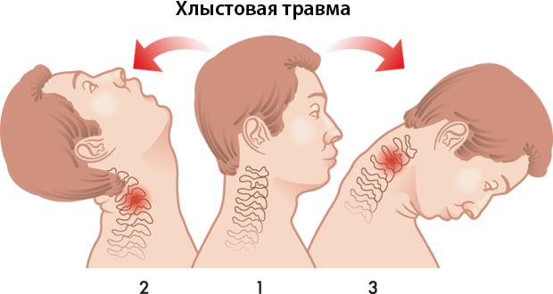 Проявление хлыстовой травмы