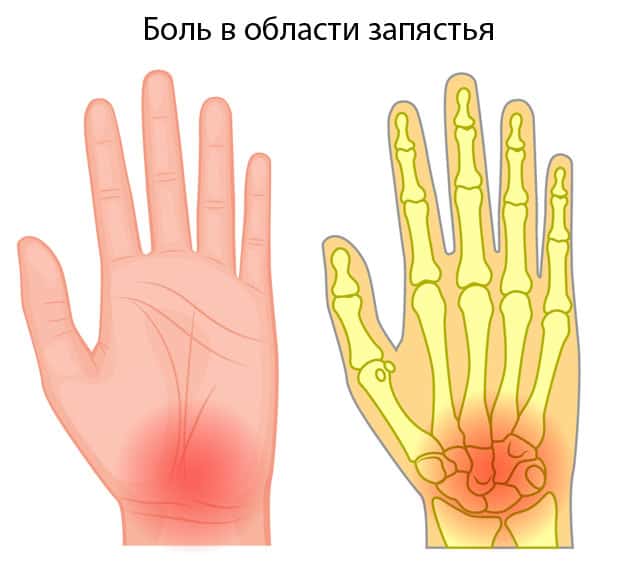 Растяжение запястья