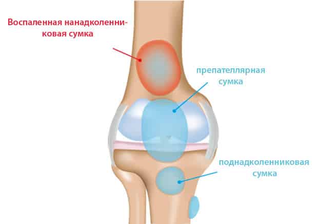 Бурсит колена