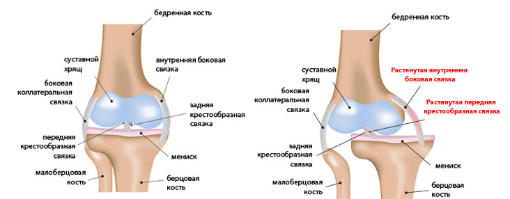 Вывих колена