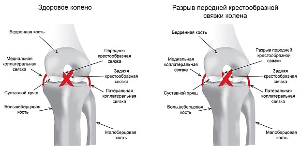 Разрыв передней крестообразной связки