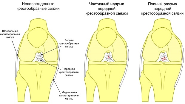 Стадии разрыва крестообразной связки