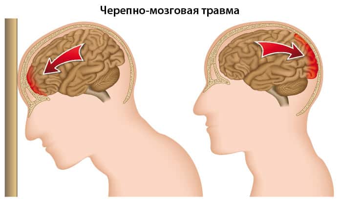 Черепно-мозговая травма