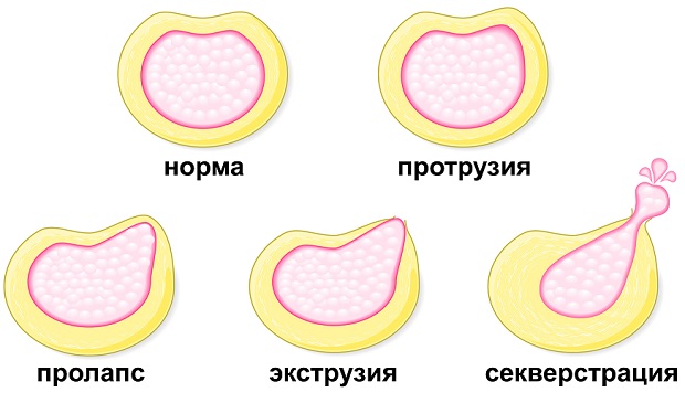 стадии грыжи