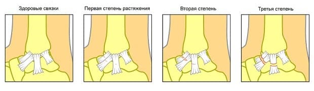 степени растяжения связок